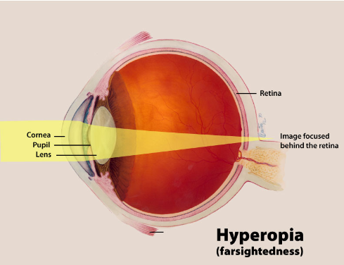 Farsightedness C Images are focused behind the retina