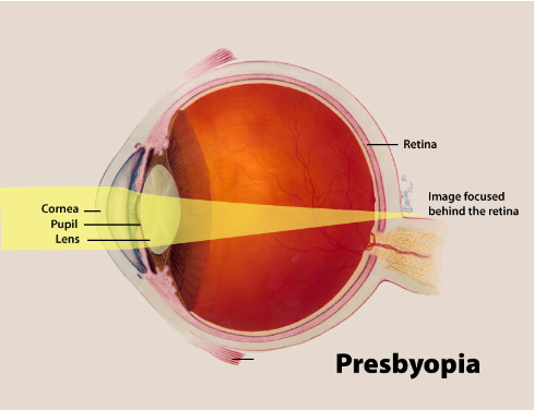What is presbyopia